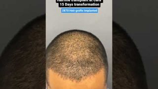 15 DAY TRANSFORMATION: See His Hair Before and After Sapphire FUE Hair Transplant