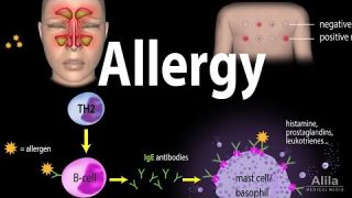 Allergy – Mechanism, Symptoms, Risk factors, Diagnosis, Treatment and Prevention, Animation
