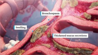 What Is Severe Asthma?