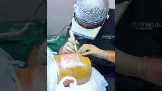 Best Price for Hair Transplant in India at Cara Clinic 2024
