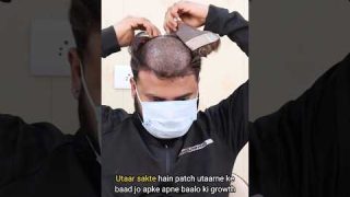 Hair patch service at home| Hair Patch Self Service| Hair Patch Service #hairloss