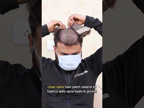 Hair patch service at home| Hair Patch Self Service| Hair Patch Service #hairloss